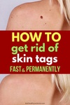 how to get rid of skin tags at home