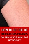 keratosis pilaris natural treatment